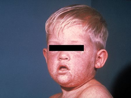 enfant_rougeole_W600 Enfant présentant des symptômes de la rougeole. © Centers for Disease Control and Prevention (CDC)