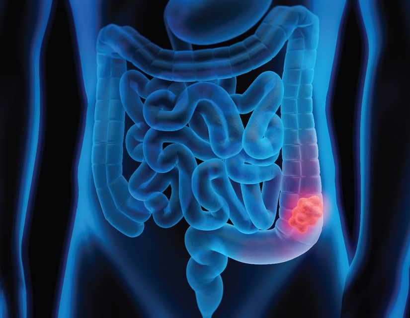 Depiction of part of the digestive system. Polyps or colorectal cancer (in red) may develop in the large intestine.