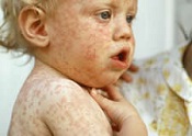 Symptômes de la rougeole. Enfant présentant des symptômes de la rougeole.