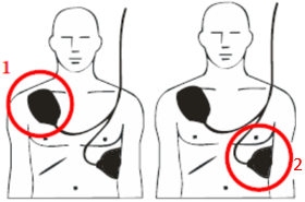 For adults, place an electrode below the right shoulder bone (right clavicle), then the 2nd electrode below the left armpit at breast level. Do not place an electrode on a transdermal patch or cardiac pacemaker.