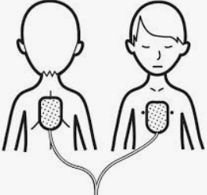 For children, place an electrode in the middle of the chest, between the breasts, and then the 2nd electrode in the middle of the back, between the shoulder blades.